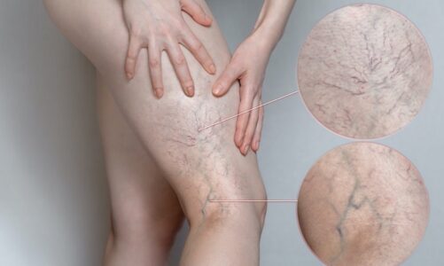 Why Might You Be Fail at Spider Vein Removal?